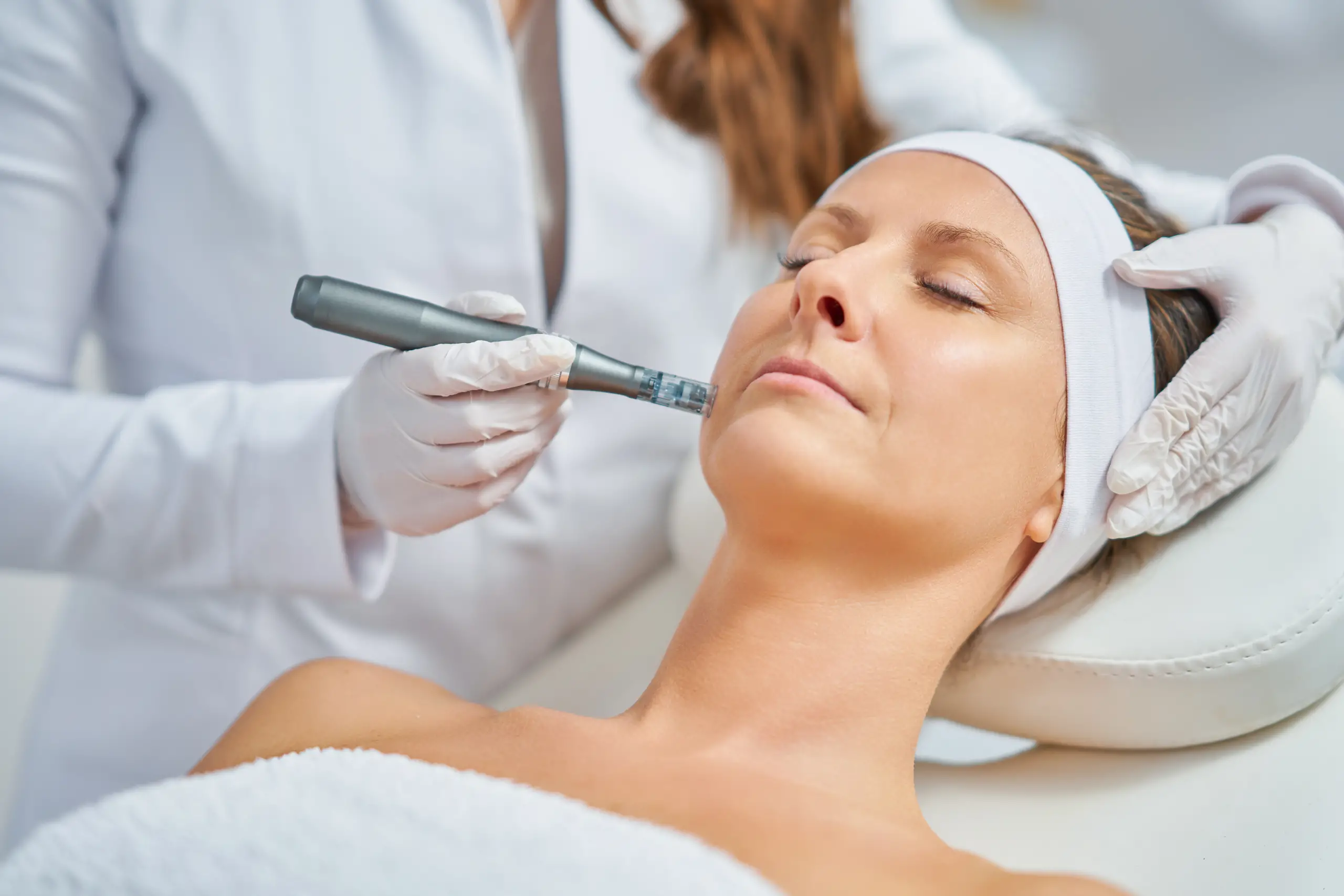 pelling facial estetica 1