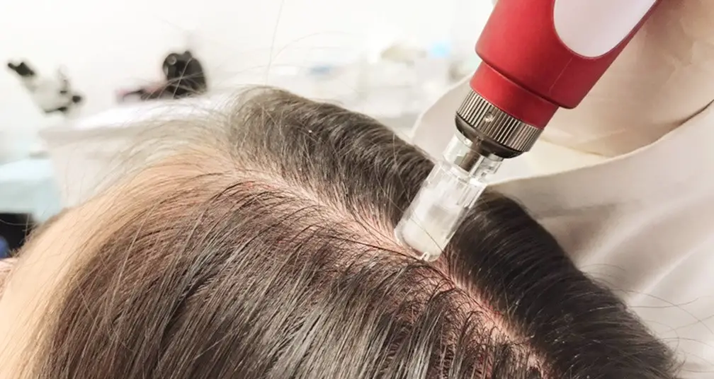 Microneedling